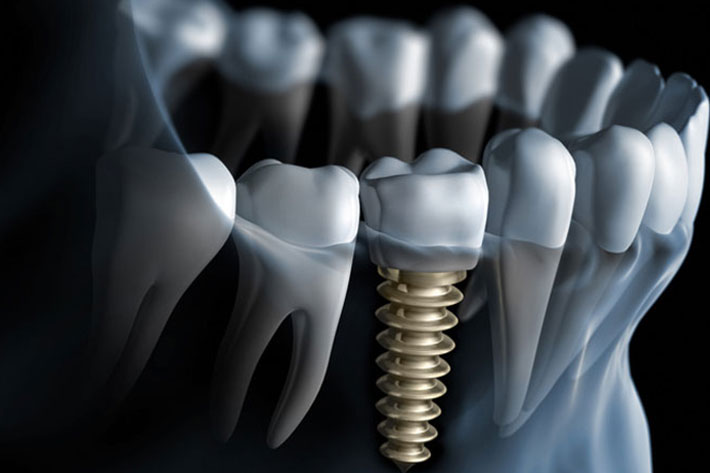 implanti za zube