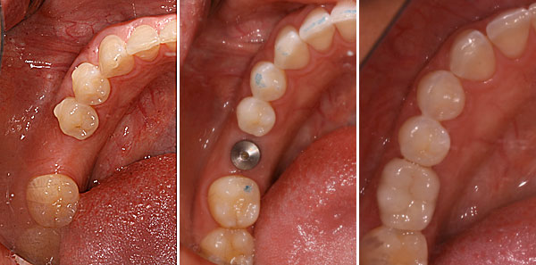 zubni implanti beograd